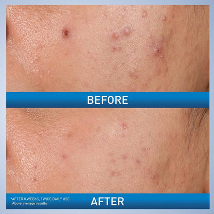 علاج حب الشباب بحمض الساليسيليك من سيرافي مع حمض الجليكوليك وحمض اللاكتيك