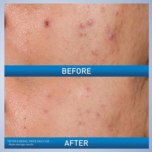 علاج حب الشباب بحمض الساليسيليك من سيرافي مع حمض الجليكوليك وحمض اللاكتيك